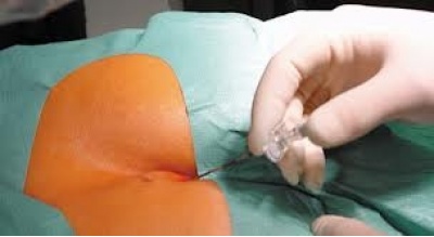Epidural catheterization on Ratsu
